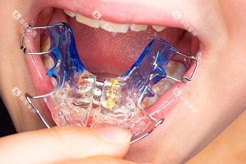 牙齿矫治器示意图