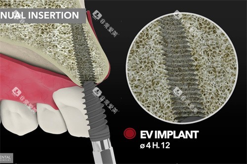 意大利BB种植牙上颌种植