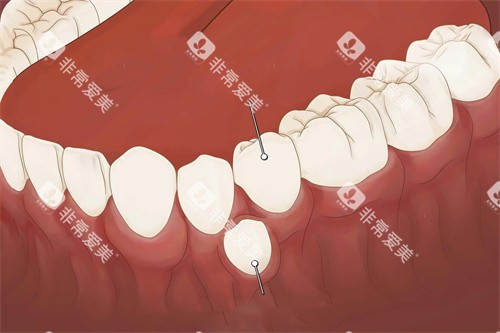 常见多生牙在外侧
