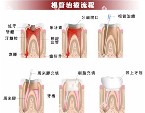 根管治疗流程