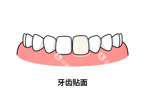 牙齿贴面卡通展示图 牙齿贴面卡通展示图