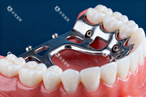 全口假牙模型展示