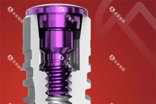 卡尔斯种植牙简介