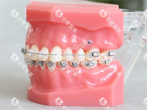 牙齿矫正金属及陶瓷托槽牙套模型图