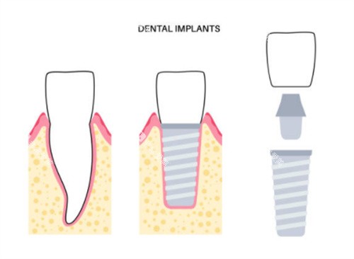 种植牙前后对比图片 种植牙前后对比图片