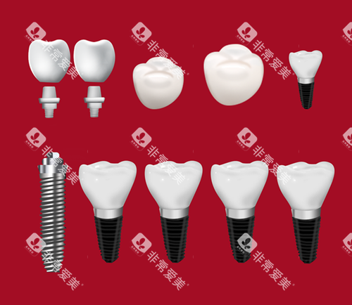 种植牙组成 种植牙组成