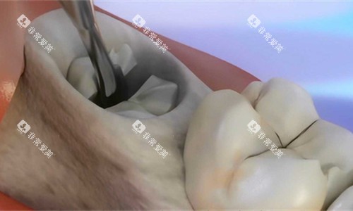 牙齿龋洞展示图