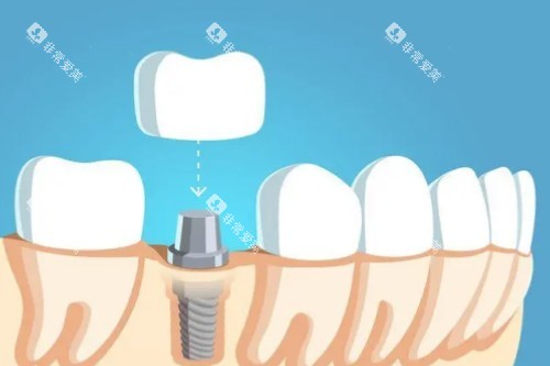 种植牙戴牙冠卡通图