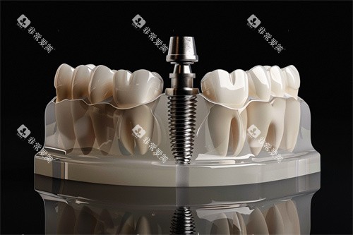 种植牙植体漫画示意图