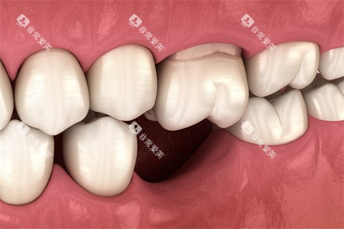 缺牙牙齿松动