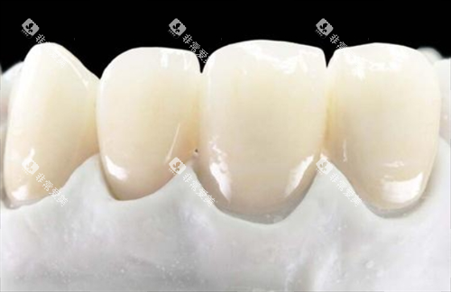 全瓷牙前牙展示