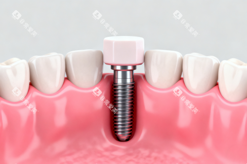 种植牙植入口腔模型图