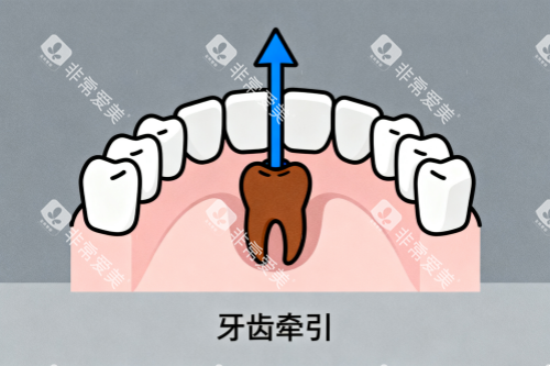 牙齿牵引卡通图 牙齿牵引卡通图