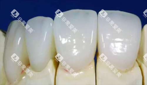 钯金烤瓷牙牙模型展示 钯金烤瓷牙牙模型展示