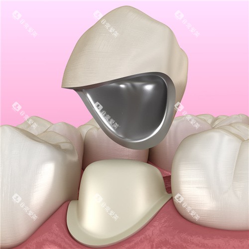 烤瓷牙动漫素材 烤瓷牙动漫素材