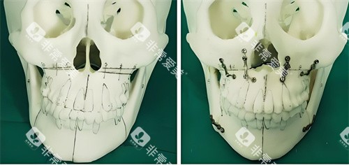 正颌手术手术原理展示图