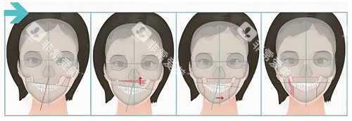 正颌手术手术步骤展示动画图