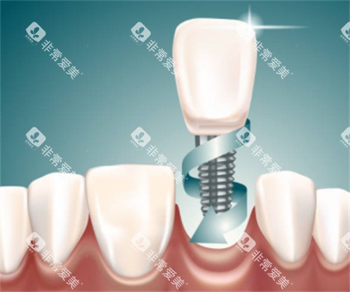 种植牙在口腔图