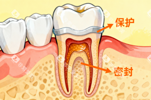 根管治疗卡通展示图 根管治疗卡通展示图