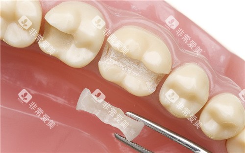 嵌体补牙