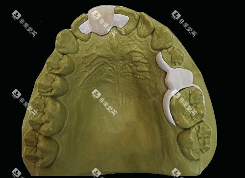 hpp粘接桥牙齿口腔内示意图 hpp粘接桥牙齿口腔内示意图