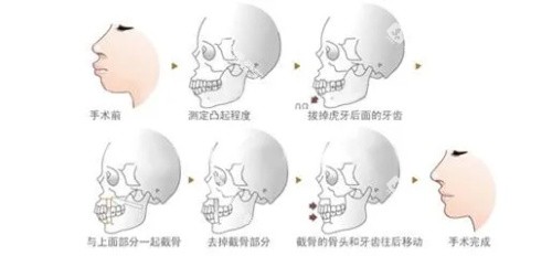 正颌手术步骤图示