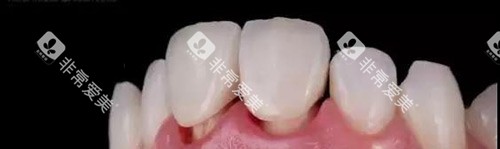 牙冠展示示意图 牙冠展示示意图