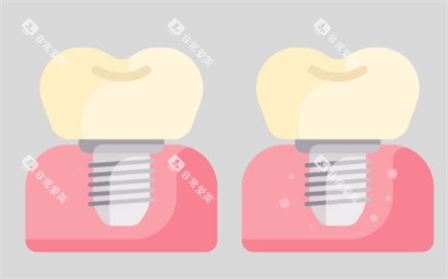 种植牙对比图 种植牙对比图
