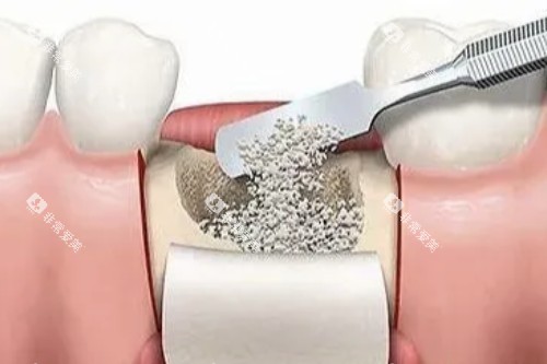 种植牙植骨图片展示