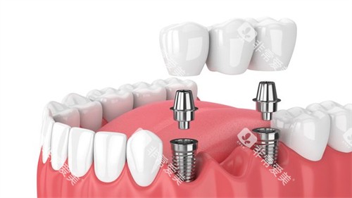 多颗种植牙图 多颗种植牙图