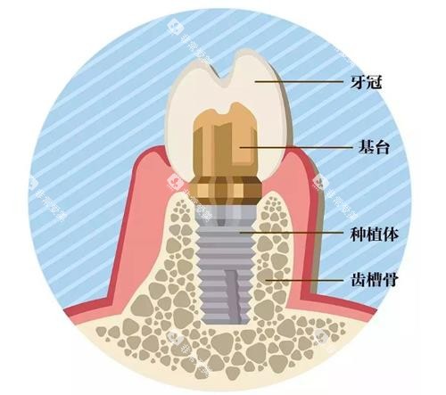 种植牙的组成 种植牙的组成