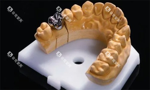 种植牙纯钛一体冠 种植牙纯钛一体冠