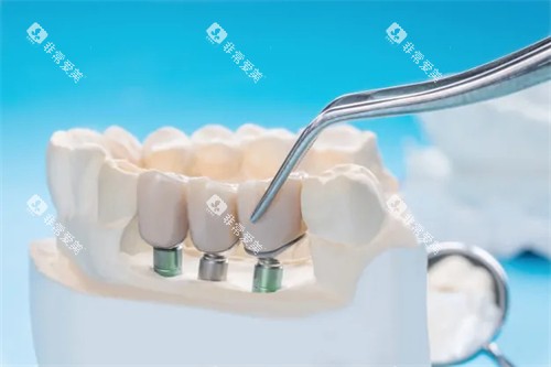 种植牙动画图展示 种植牙动画图展示