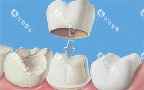 全瓷牙冠安装 全瓷牙冠安装