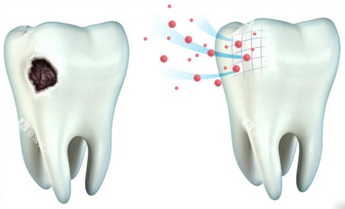 牙齿牙釉质龋坏和正常牙釉质 牙齿牙釉质龋坏和正常牙釉质