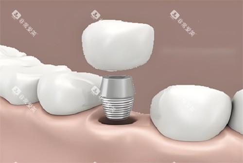 种植牙图片展示图片