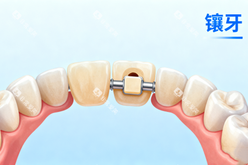 镶牙与正常牙齿对比图 镶牙与正常牙齿对比图
