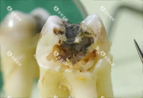 烂牙齿图片展示 烂牙齿图片展示