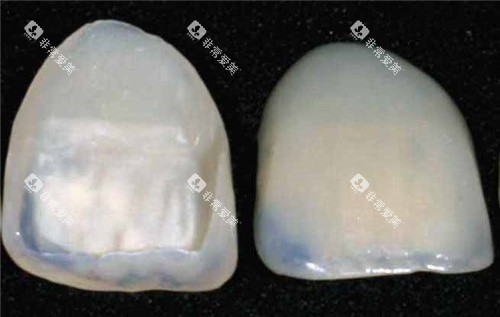 牙齿贴面成品 牙齿贴面成品