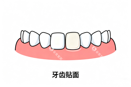 牙齿贴面卡通展示图 牙齿贴面卡通展示图