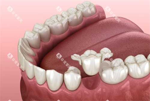 牙齿修复动画展示图 牙齿修复动画展示图