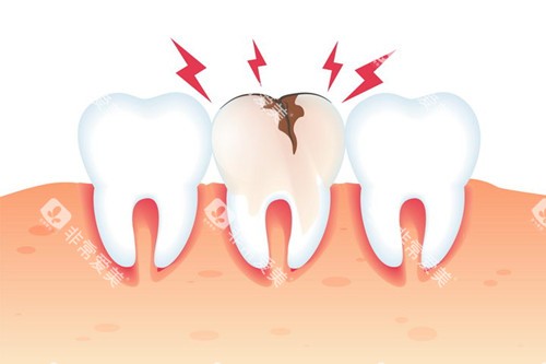 牙齿破裂 牙齿破裂