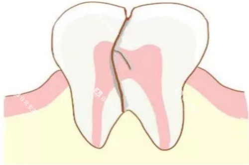 牙齿隐裂卡通图 牙齿隐裂卡通图