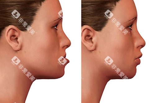 牙齿矫正对比图 牙齿矫正对比图