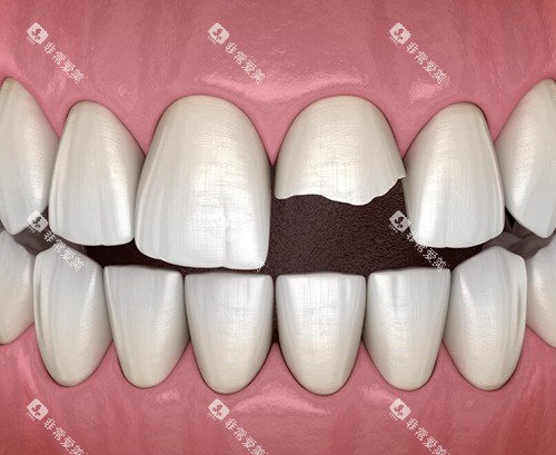 牙齿缺损图 牙齿缺损图