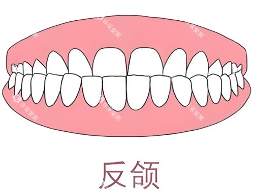 牙齿反颌卡通示意图 牙齿反颌卡通示意图