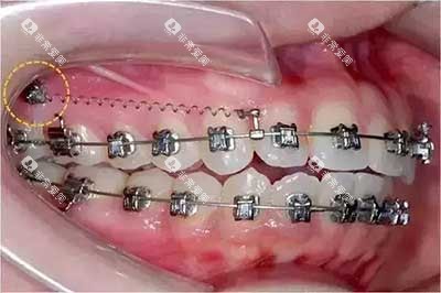 牙齿矫正骨钉种植钉2 牙齿矫正骨钉种植钉2