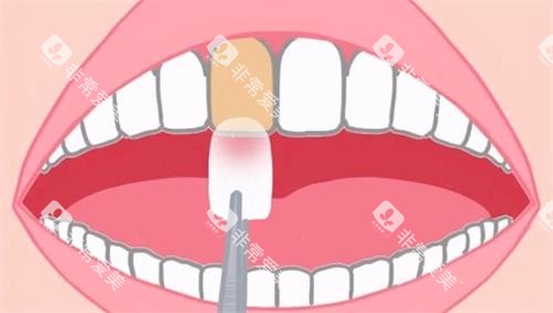 牙齿贴面动画示意图