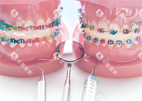 牙齿矫正模型图片 牙齿矫正模型图片