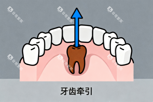 牙齿牵引卡通图 牙齿牵引卡通图